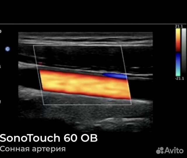 Узи-аппарат Sonotouch 60
