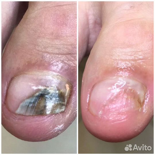 Педикюр подолог