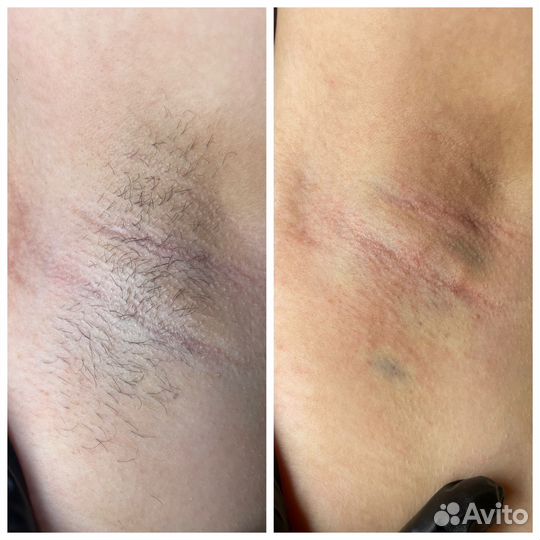 Электроэпиляция