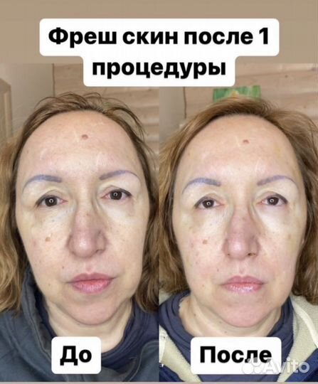 Мезотерапия лица