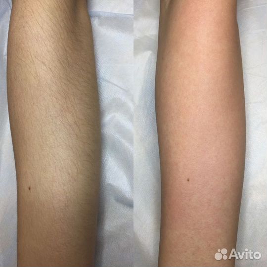 Восковая депиляция