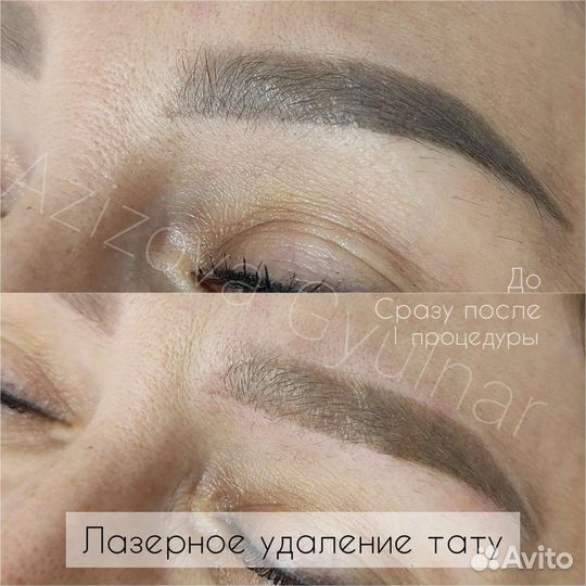 Удаление тату/татуажа (перманента)