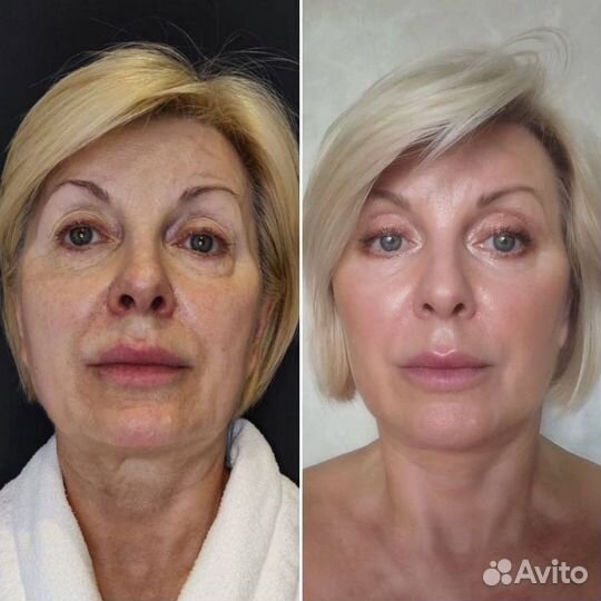 Элос Омоложение и Эпиляция