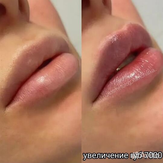 Увеличение губ