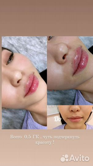 Ботокс для лица