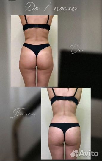 Аппаратный вакуумный массаж вибро баночный массаж