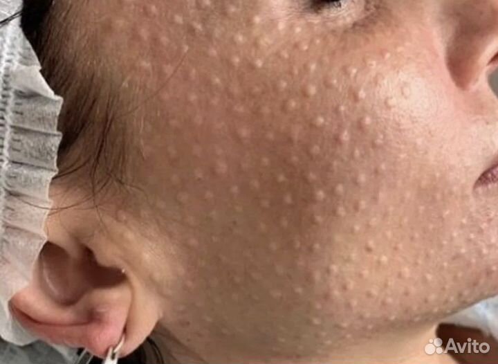 Биоревитализация