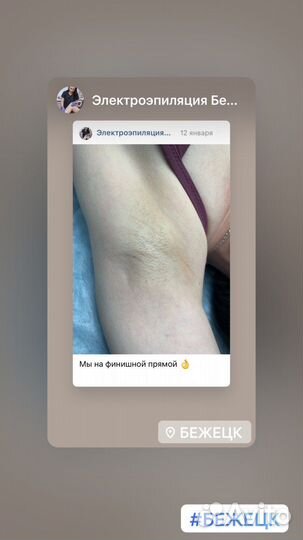 Удаление волос навсегда