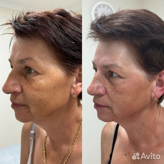 Омолаживающий массаж лица