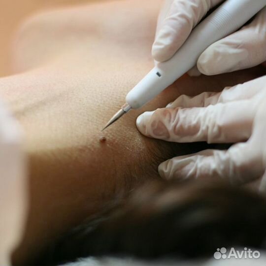 Удаление папилом, родинок, шипиц