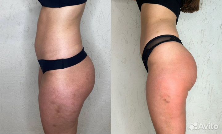 Аппаратный массаж