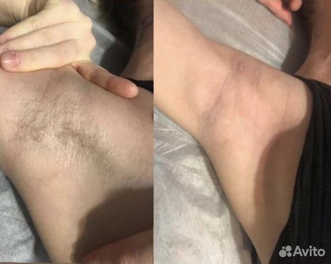 Эпиляция шугаринг