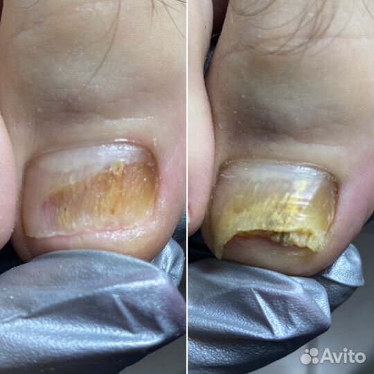 Подологический уход любой сложности