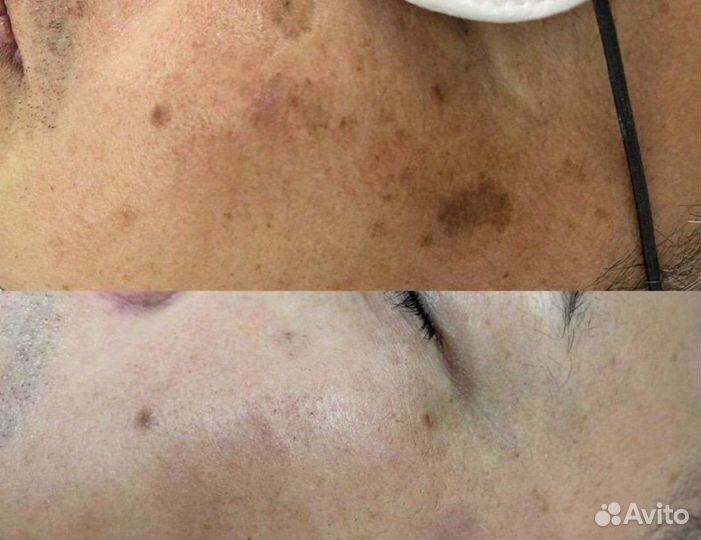 Удаление пигментных пятен