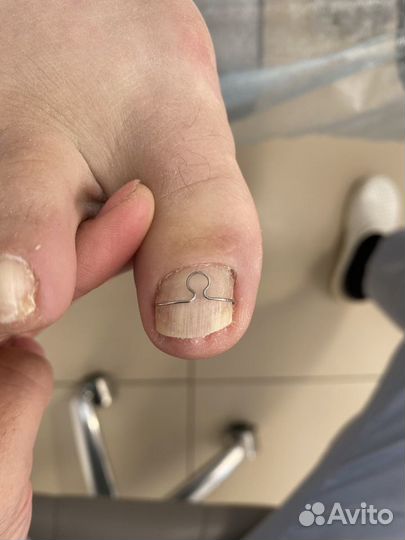 Вросший ноготь