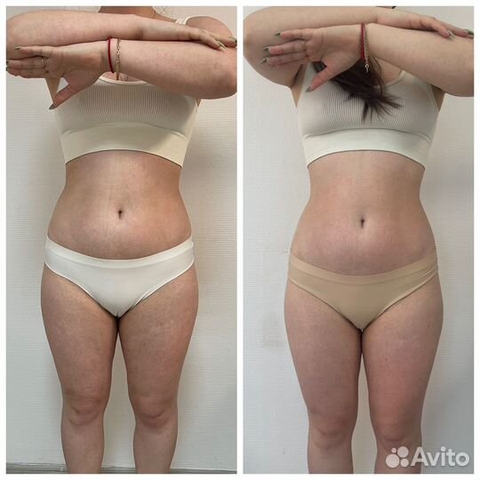 LPG массаж антицеллюлитный