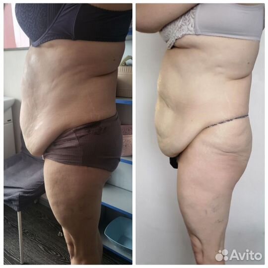 LPG массаж. Лазерный липолиз, Вакуумный массаж