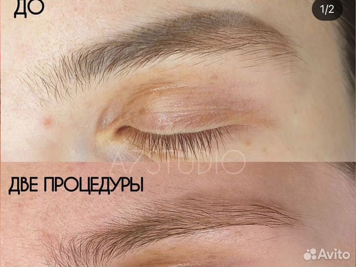 Лазерное удаление татуажа Удалить татуаж