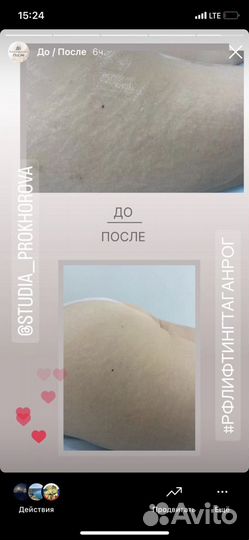 LPG массаж. Кавитация.RFлифтинг.Миостимуляция