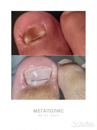 Мед. Педикюр1500/Титан1500