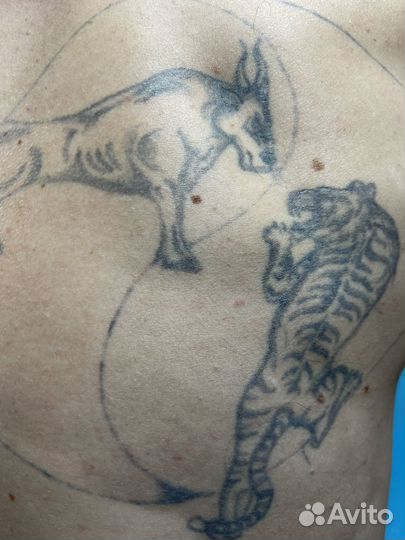 Лазерное удаление татуажа и татуировок