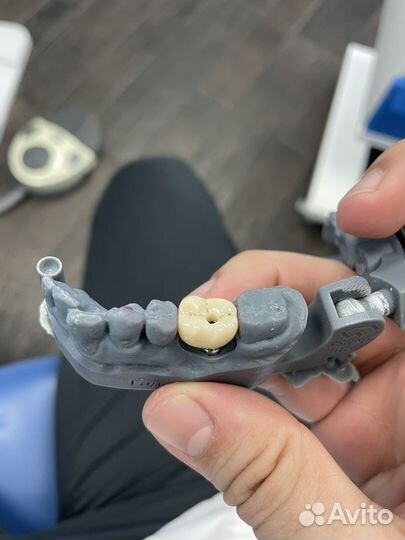 Коронка на имплант