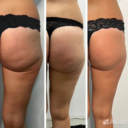 Минус 1 см за сеанс. Преображение тела без усилий