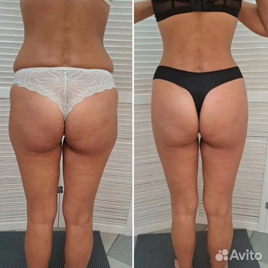 Вакуумный аппаратный массаж, обертывание