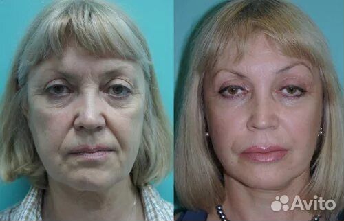 Массаж лица