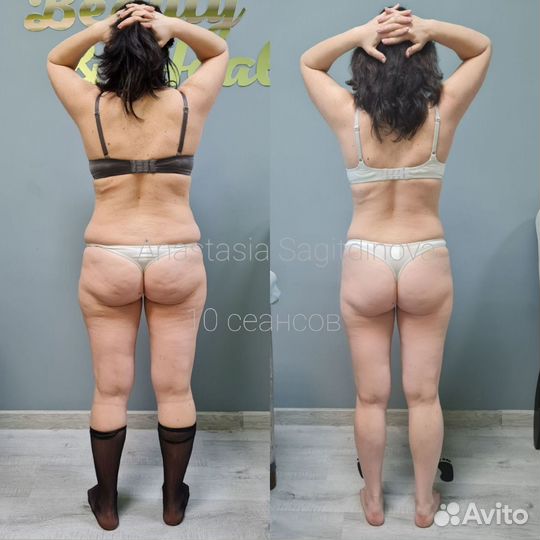 Антицеллюлитный массаж vela shape, LPG, вакуумный