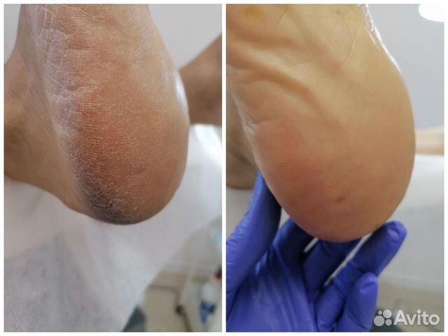 Сертифицированный подолог, лечебный педикюр