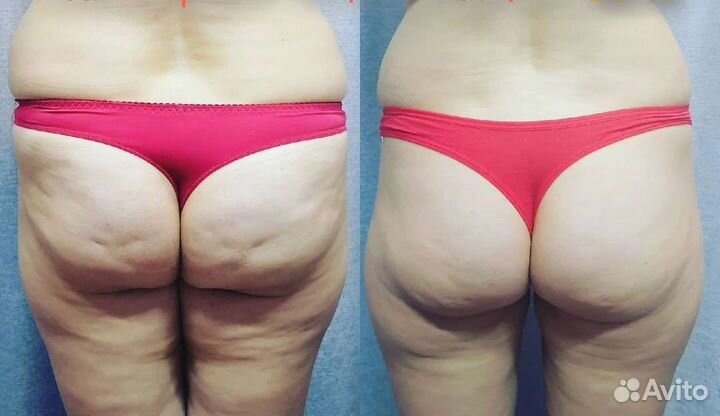 Коррекция фигуры