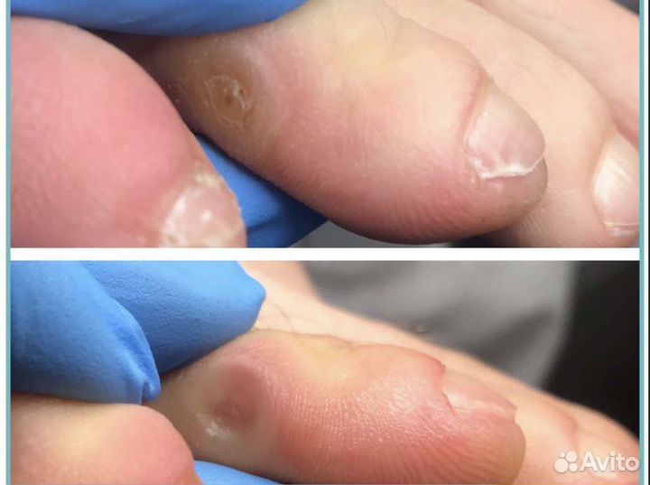 Педикюр, сложные случаи, пластины на ногти