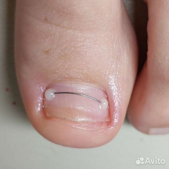 Титановая нить педикюр