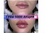Увеличение губ контурная пластика губ косметолог