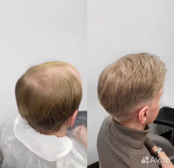 Мужская система волос, 