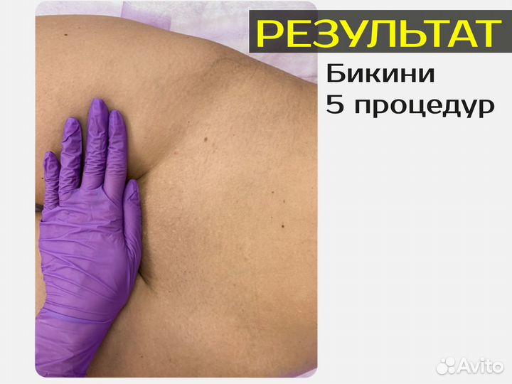 Лазерная эпиляция Все тело