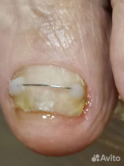 Медицинский педикюр, педикюр