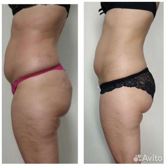 Вакуумный массаж, Кавитация, Rf лифтинг