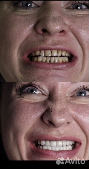 Фотокомпозитные Виниры 5000