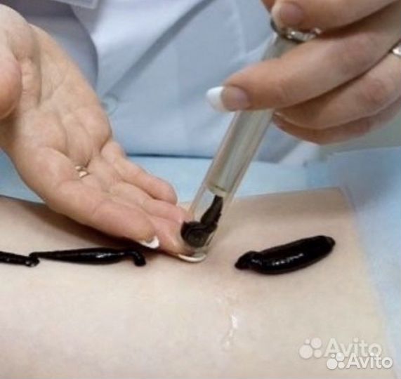 Пиявки медицинские