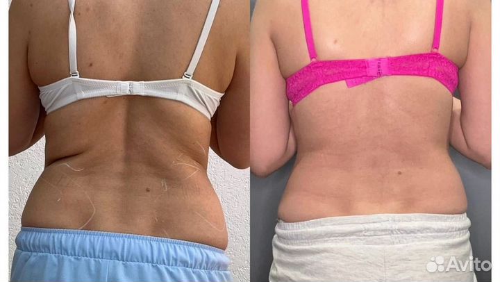 Липолитики лицо, тело