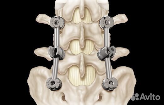 Металлоконструкция для позвоночника