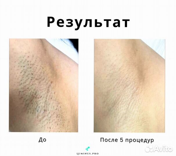 Диодный лазер для эпиляции «Lumines» Макс’Ван 1200 Вт