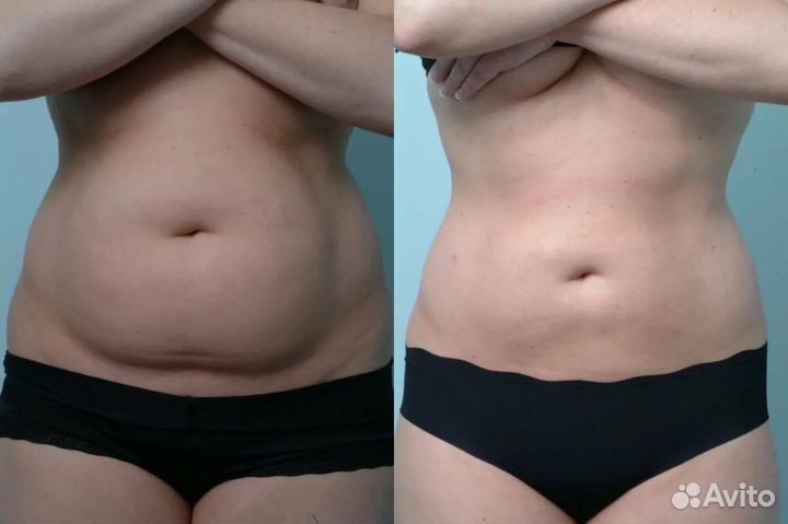 Аппратный Lpg массаж