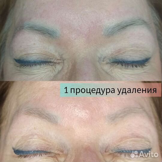 Удаление татуажа и татуировок ремувером