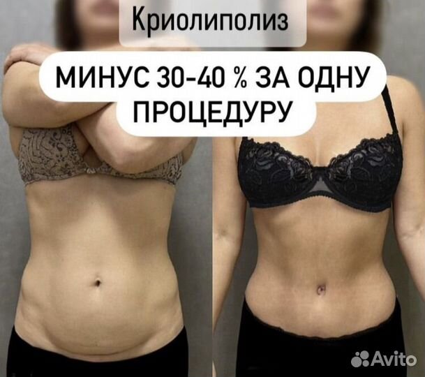 Криолиполиз