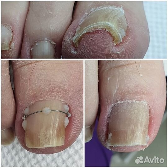 Титановая нить, Вросший ноготь. Подолог