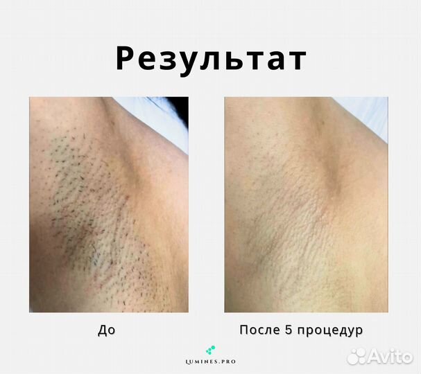 Диодный лазер Lumines MaxOne 1200W