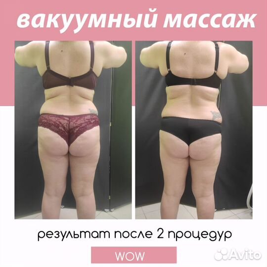 Модель на криолиполиз, вакуумный массаж, кавитация